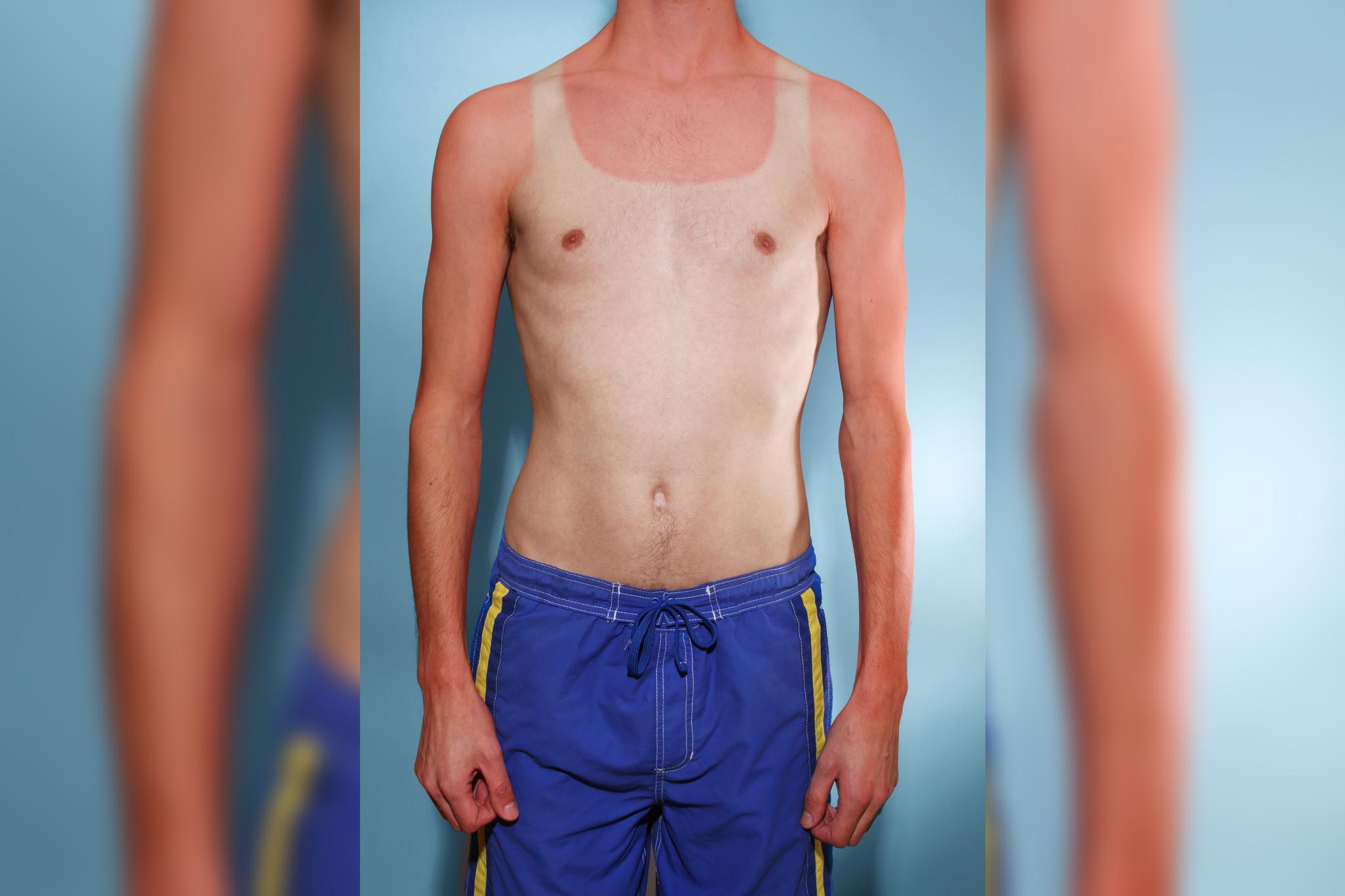 Researchers found that vitamin D decreased the symptoms of sunburn after the fact. But it's still best to wear sunscreen and protective clothing.