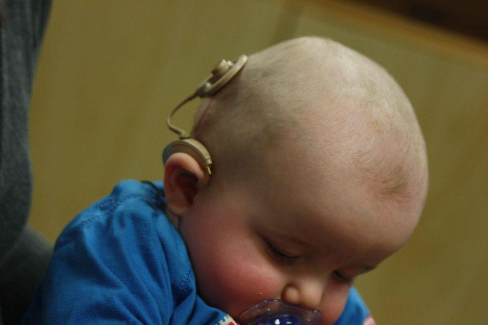 cochlear implant