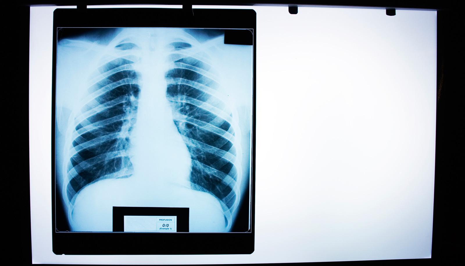 lung xray